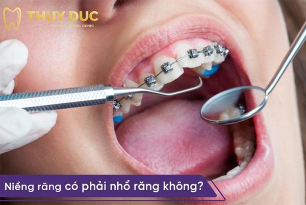 Phuong-phap-nieng-rang-khong-dau-tai-nha-khoa-thuy-duc